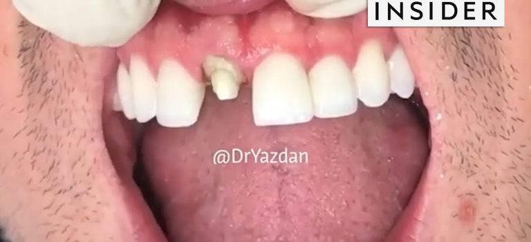 Dental Practice Financing For Dentists – Call BRT: 904-551-6090:  How Dentists Create Tooth Veneers And Crowns