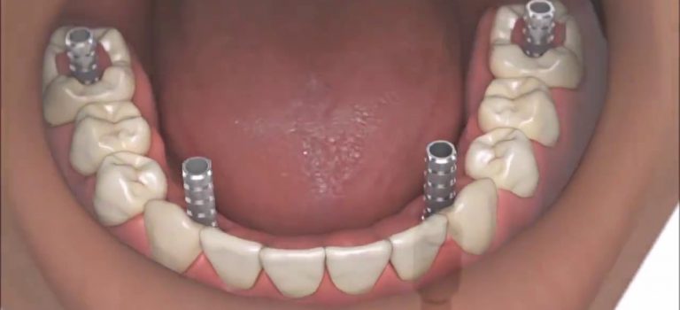 Dental Practice Financing For Dentists – Call BRT: 904-551-6090:  Dental Implants Coventry Dentists Show Best Same Day Full Whole Mouth Dental Teeth Implants Verum UK