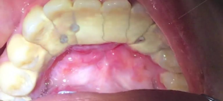 Dental Practice Financing For Dentists – Call BRT: 904-551-6090:  Houston Cosmetic Dentist…Worst Tartar I have seen! Watch how we remove it…