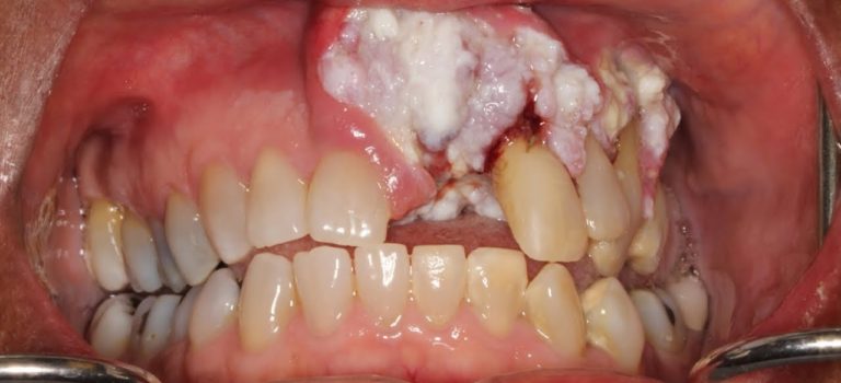 Dental Practice Financing For Dentists – Call BRT: 904-551-6090:  Woman's Mouth Cancer Goes Ignored by Dentists for Years