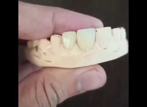 Dental Practice Financing For Dentists – Call BRT: 904-551-6090:  Smile Makeover With Porcelain Veneers| Best Cosmetic Dentist in Bangalore| Dr K N Trivikram Rao