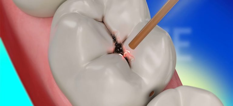 Dental Practice Financing For Dentists – Call BRT: 904-551-6090:  Dental Restoration with Waterlase Laser Dentistry – BIOLASE