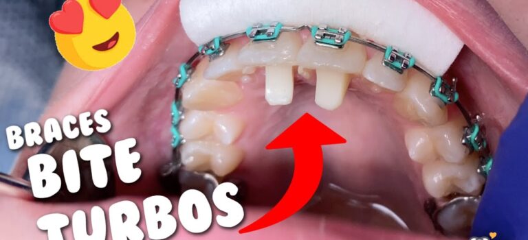 Dental Practice Financing For Dentists – Call BRT: 904-551-6090:  Braces Bite Turbos – Tooth Time Family Dentistry New Braunfels Texas