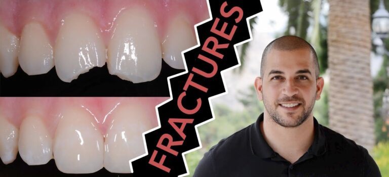 Dental Practice Financing For Dentists – Call BRT: 904-551-6090:  How to Repair a Broken Tooth with Dentist Filling (Dentist)