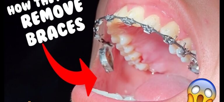 Dental Practice Financing For Dentists – Call BRT: 904-551-6090:  How they remove braces – Dental Braces Tooth Time Family Dentistry New Braunfels