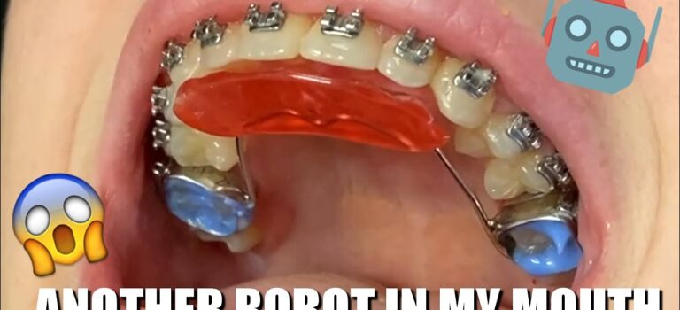 Dental Practice Financing For Dentists – Call BRT: 904-551-6090:  Braces in New Braunfels : Bite Plate / ToothTime Dentist Seguin and San Antonio