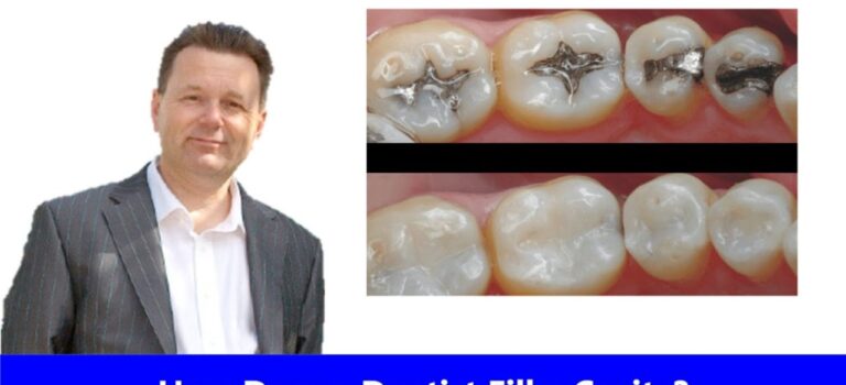 Dental Practice Financing For Dentists – Call BRT: 904-551-6090:  How Does a Dentist Fill a Cavity?