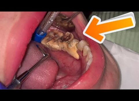 Dental Practice Financing For Dentists – Call BRT: 904-551-6090:  SCALING CALCULUS | Dentist | Dokter Gigi Tri Putra