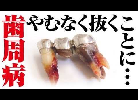 Dental Practice Financing For Dentists – Call BRT: 904-551-6090:  【やむなく】重度の歯周病での抜歯Tooth extraction[dentistry] [periodontitis] [cleaning] [health and wellness](拔牙)