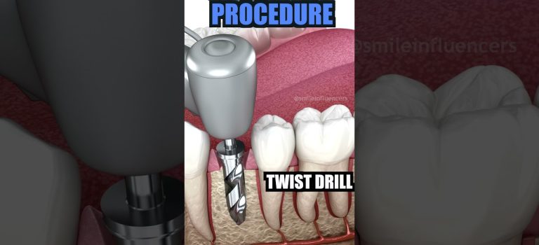 Dental Practice Financing For Dentists – Call BRT: 904-551-6090:  All on 4 Dental Implants Explained