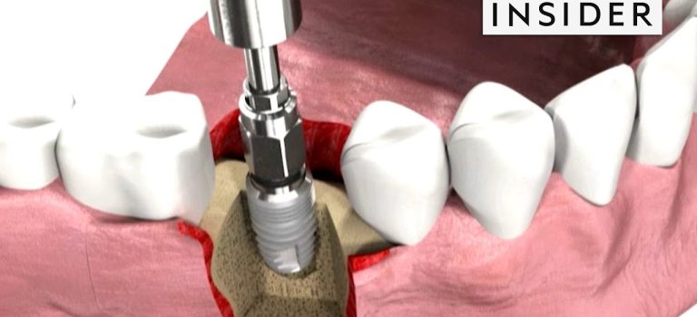 Dental Practice Financing For Dentists – Call BRT: 904-551-6090:  How Dentists Insert Dental Implants