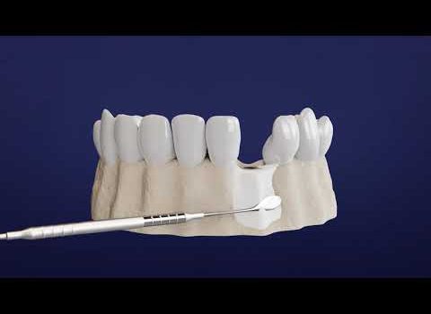 Dental Practice Financing For Dentists – Call BRT: 904-551-6090:  Step by Step Guide to Your Dental Implant Procedure Dental Practice Financing For Dentists – Call BRT: 904-551-6090:  Step by Step Guide to Your Dental Implant Procedure