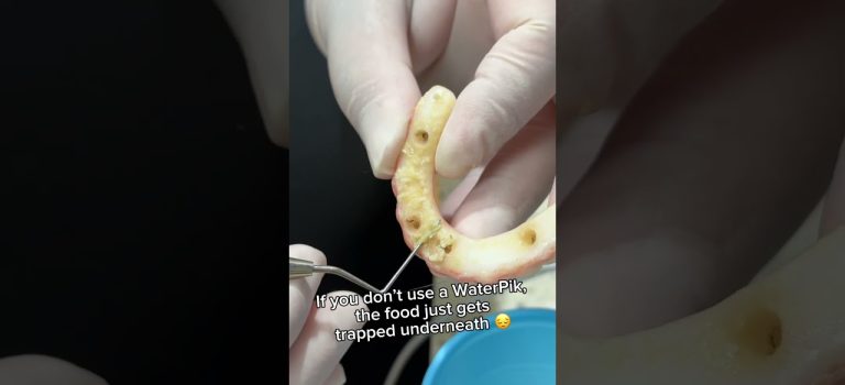 Dental Practice Financing For Dentists – Call BRT: 904-551-6090:  Clean your All on 4 Dental Implants ⚠️ #Shorts #WaterPik #Dentist #dentalhygiene #Allon4